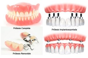prótesis odontológicas